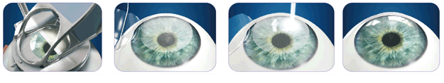 雷射LASIK-雷射角膜層狀重塑術