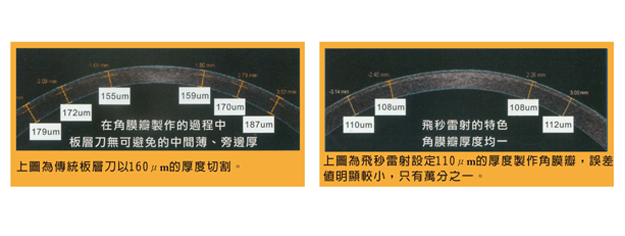 飛秒雷射VS傳統板層刀雷射